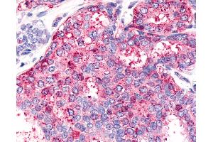 Anti-HNF4G / HNF4 Gamma antibody IHC of human Breast, Carcinoma. (HNF4 gamma 抗体  (Internal Region))