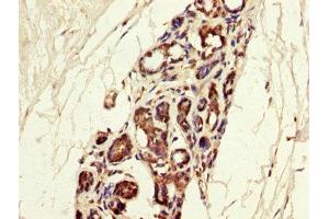 IHC image of ABIN7159059 diluted at 1:300 and staining in paraffin-embedded human breast cancer performed on a Leica BondTM system.