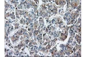 Immunohistochemical staining of paraffin-embedded Carcinoma of liver tissue using anti-BSG mouse monoclonal antibody. (CD147 抗体)
