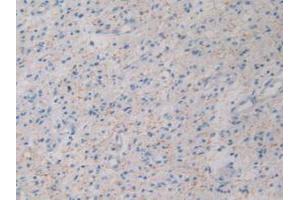 DAB staining on IHC-P; Samples: Human Glioma Tissue. (GHRH 抗体  (AA 19-108))