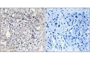 Immunohistochemistry analysis of paraffin-embedded human liver carcinoma tissue, using Heparin Cofactor II Antibody. (SERPIND1 抗体  (AA 41-90))