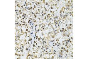 Immunohistochemistry of paraffin-embedded human kidney cancer using IFI16 Antibody (ABIN6129036, ABIN6142162, ABIN6142163 and ABIN6218202) at dilution of 1:100 (40x lens). (IFI16 抗体  (AA 1-300))