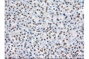 Immunohistochemical staining of paraffin-embedded Adenocarcinoma of Human colon tissue using anti-CYP1A2 mouse monoclonal antibody. (CYP1A2 抗体)