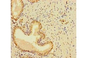 Immunohistochemistry of paraffin-embedded human prostate cancer using ABIN7166969 at dilution of 1:100 (RABEP2 抗体  (AA 301-533))