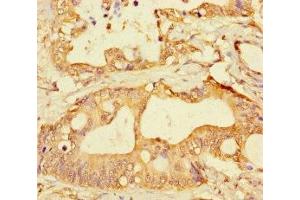 Immunohistochemistry of paraffin-embedded human colon cancer using ABIN7153335 at dilution of 1:100 (GPR183 抗体  (AA 1-31))