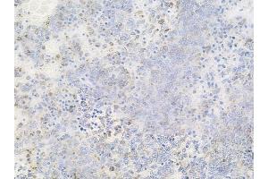 ABIN6256556 and ABIN6267493 at 1/100 staining human melanoma by IHC-P.