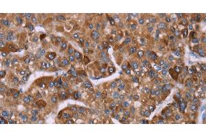 Immunohistochemistry of paraffin-embedded Human liver cancer tissue using HSP10 Polyclonal Antibody at dilution 1:40 (HSPE1 抗体)