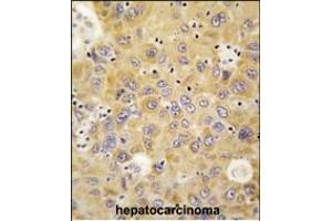 Formalin-fixed and paraffin-embedded human hepatocarcinoma tissue reacted with RS antibody (N-term) (ABIN391804 and ABIN2841658) , which was peroxidase-conjugated to the secondary antibody, followed by DAB staining. (AARS 抗体  (N-Term))