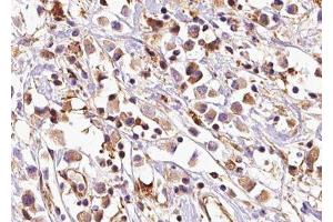 ABIN6279152 at 1/100 staining Human breast cancer tissue by IHC-P.