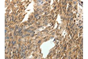 The image on the left is immunohistochemistry of paraffin-embedded Human ovarian cancer tissue using ABIN7131276(SYT7 Antibody) at dilution 1/15, on the right is treated with fusion protein. (SYT7 抗体)