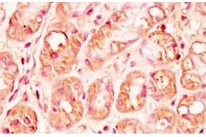 Human stomach cancer tissue was stained by rabbit Anti-Spexin prepro (73-116)  (H) Antibody (Spexin 抗体  (Preproprotein))