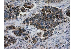 Immunohistochemical staining of paraffin-embedded Carcinoma of Human lung tissue using anti-LGALS3BP mouse monoclonal antibody.