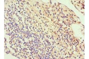 Immunohistochemistry of paraffin-embedded human cervical cancer using ABIN7170114 at dilution of 1:100 (GLUT1 抗体  (AA 210-310))