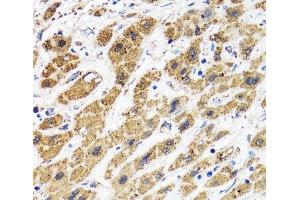 Immunohistochemistry of paraffin-embedded Human liver cancer using HAPLN1 Polyclonal Antibody at dilution of 1:100 (40x lens). (HAPLN1 抗体)
