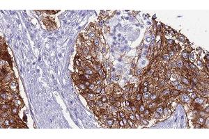 ABIN6276794 at 1/100 staining Human urothelial cancer tissue by IHC-P. (CD46 抗体  (N-Term))