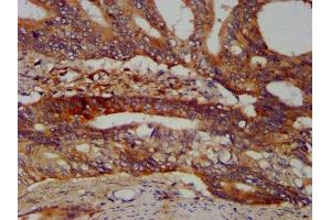 IHC image of ABIN7168210 diluted at 1:400 and staining in paraffin-embedded human colon cancer performed on a Leica BondTM system. (SBDS 抗体  (AA 37-153))