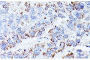 Immunohistochemistry of paraffin-embedded Human liver cancer using CCDC6 Polyclonal Antibody at dilution of 1:100 (40x lens). (CCDC6 抗体)