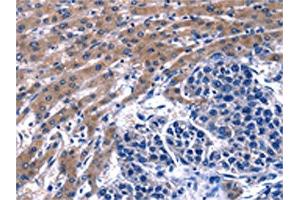 The image on the left is immunohistochemistry of paraffin-embedded Human liver cancer tissue using ABIN7129604(GIP Antibody) at dilution 1/13, on the right is treated with fusion protein. (GIP 抗体)