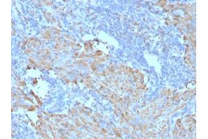 Formalin-fixed, paraffin-embedded human GIST stained with CD117 Mouse Monoclonal Antibody (C117/370). (KIT 抗体)