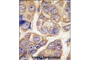 Formalin-fixed and paraffin-embedded human breast carcinoma tissue reacted with CDH13 antibody , which was peroxidase-conjugated to the secondary antibody, followed by DAB staining. (Cadherin 13 抗体  (C-Term))