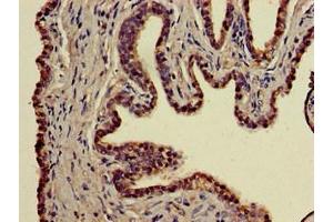 Immunohistochemistry of paraffin-embedded human prostate cancer using ABIN7155629 at dilution of 1:100 (BBX 抗体  (AA 62-292))