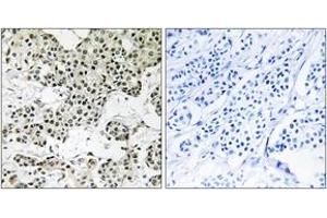 Immunohistochemistry analysis of paraffin-embedded human breast carcinoma tissue, using THOC5 Antibody. (THO Complex 5 抗体  (AA 561-610))