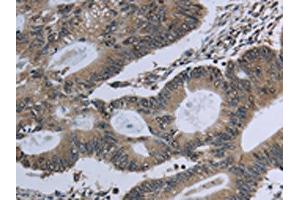 The image on the left is immunohistochemistry of paraffin-embedded Human colon cancer tissue using ABIN7129632(GNG2 Antibody) at dilution 1/60, on the right is treated with fusion protein. (GNG2 抗体)