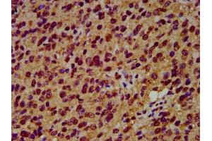 IHC image of ABIN7151218 diluted at 1:600 and staining in paraffin-embedded human glioma performed on a Leica BondTM system. (SIAH2 抗体  (AA 1-72))