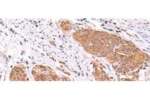 Immunohistochemistry of paraffin-embedded Human esophagus cancer tissue using ASTN2 Polyclonal Antibody at dilution of 1:80(x200) (Astrotactin 2 抗体)