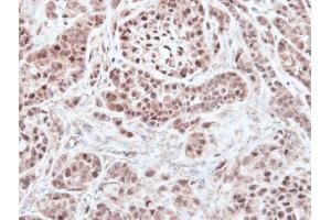 IHC-P Image Immunohistochemical analysis of paraffin-embedded A549 xenograft, using RNF13, antibody at 1:500 dilution. (RNF13 抗体  (C-Term))