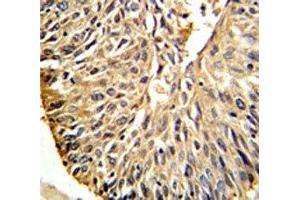 DHFR antibody IHC analysis in formalin fixed and paraffin embedded human lung carcinoma. (Dihydrofolate Reductase 抗体  (AA 135-164))