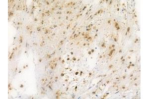 ABIN6261409 and ABIN6269309 at 1/100 staining human breast carcinoma by IHC-P. (E2F1 抗体  (C-Term))