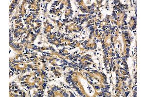 ABIN7096696 and ABIN7100761 at 1/100 staining human colorectal cancer by IHC-P. (SPPL2B 抗体)