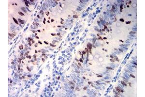 Immunohistochemical analysis of paraffin-embedded rectum cancer tissues using TOP2A mouse mAb with DAB staining. (Topoisomerase II alpha 抗体  (AA 1100-1530))
