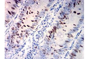 Immunohistochemical analysis of paraffin-embedded rectum cancer tissues using TOP2A mouse mAb with DAB staining.