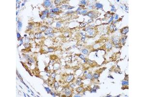 Immunohistochemistry of paraffin-embedded Human breast cancer using NDE1 Polyclonal Antibody at dilution of 1:100 (40x lens). (NDE1 抗体)