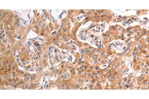 Immunohistochemistry of paraffin-embedded Human liver cancer tissue using TRPV4 Polyclonal Antibody at dilution 1:40 (TRPV4 抗体)