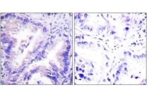 Immunohistochemistry analysis of paraffin-embedded human lung carcinoma tissue, using PP2A-alpha (Ab-307) Antibody. (PPP2CA 抗体  (AA 260-309))