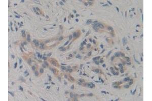 Detection of PIK3C3 in Human Pancreatic cancer Tissue using Polyclonal Antibody to Phosphoinositide-3-Kinase Class 3 (PIK3C3) (PIK3C3 抗体  (AA 631-885))