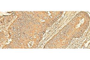 Immunohistochemistry of paraffin-embedded Human colorectal cancer tissue using RPS28 Polyclonal Antibody at dilution of 1:30(x200) (RPS28 抗体)