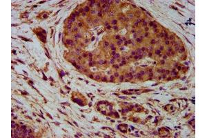 IHC image of ABIN7161114 diluted at 1:400 and staining in paraffin-embedded human pancreatic cancer performed on a Leica BondTM system. (PVRL4 抗体  (AA 91-199))