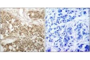 Immunohistochemistry analysis of paraffin-embedded human breast carcinoma, using PKC thet (Phospho-Ser676) Antibody. (PKC theta 抗体  (pSer676))