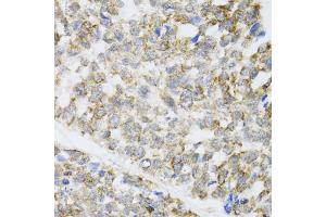 Immunohistochemistry of paraffin-embedded human esophageal cancer using ZAK antibody. (ZAK 抗体)