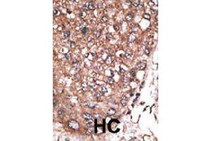 Formalin-fixed and paraffin-embedded human hepatocellular carcinoma tissue reacted with HAND2 polyclonal antibody  , which was peroxidase-conjugated to the secondary antibody, followed by AEC staining. (HAND2 抗体  (C-Term))