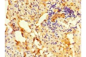 Immunohistochemistry of paraffin-embedded human lung cancer using ABIN7168333 at dilution of 1:100 (RBM12 抗体  (AA 1-200))