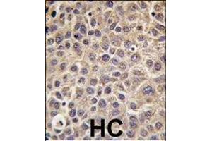 Formalin-fixed and paraffin-embedded human hepatocarcinoma tissue reacted with MTMR9 antibody , which was peroxidase-conjugated to the secondary antibody, followed by DAB staining. (MTMR9 抗体  (C-Term))