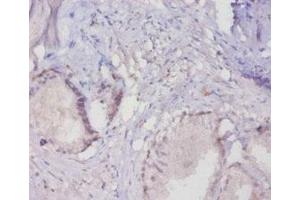 Immunohistochemistry of paraffin-embedded human prostate tissue using ABIN7160281 at dilution of 1:20 (MUC16 抗体  (AA 14067-14328))