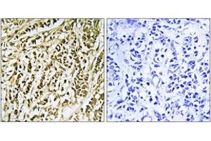 Immunohistochemistry analysis of paraffin-embedded human breast carcinoma tissue, using FEN1 Antibody. (FEN1 抗体  (AA 86-135))