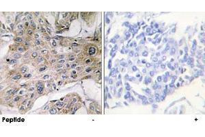 Immunohistochemistry analysis of paraffin-embedded human breast carcinoma tissue using COX7A2P2 polyclonal antibody . (COX7A2P2 抗体)