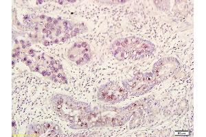 Formalin-fixed and paraffin embedded human gastric carcinoma labeled with Rabbit Anti BMI1/PCGF4 Polyclonal Antibody, Unconjugated (ABIN682678) at 1:200 followed by conjugation to the secondary antibody and DAB staining (BMI1 抗体  (AA 61-160))